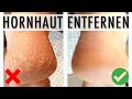 5 Möglichkeiten HORNHAUT zu entfernen ● HORNHAUT ENTFERNEN