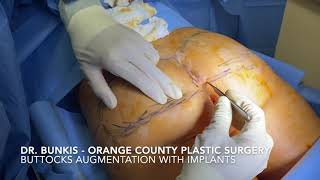 Butt Implants - Orange County Plastic Surgery