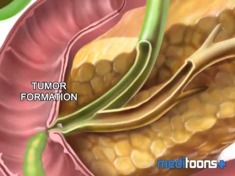 Tumor Sphincter Of Oddi - Meditoons™ - YouTube