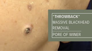 *THROWBACK* Massive Blackhead Removal POW!| Dr. Derm