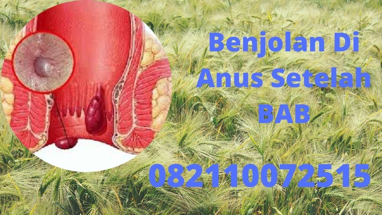 Benjolan Di Anus Setelah BAB - YouTube