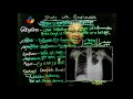 pneumonia নিউমোনিয়া ভাইরাল এবং ব্যাকটেরিয়া ঘটিত viral and bacterial pneumonia covid 19