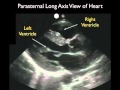 Cardiac Ultrasound - Parasternal Long Axis - Part 1 - Sonosite, Inc.