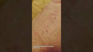 Skin rashes. Treatment of skin rashes? Causes of skin rashes.rashes on skin.skin rashes treatment.