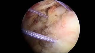 Single-Stage Arthroscopic Cartilage Repair With Injectable Scaffold and BMAC