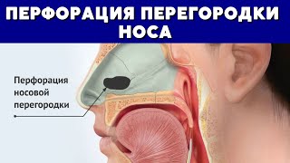 😨 Перфорация перегородки носа❗️Выкинь сосудосуживающие капли!