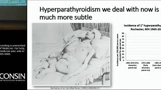 9/7/18: Hyperparathyroidism: Beyond Stones and Bones