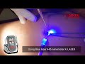 Wart removal using laser