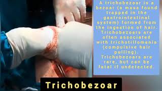 Case of trichobezoar