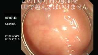 大腸内視鏡検査　TypeB No.10　Colonoscopy