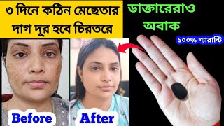 তিন দিনে কঠিন মেছেতার দাগ দূর হবে চিরতরে / Reduce Melasma, pigmentation, discoloration, blackspots