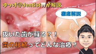 「歯の移植」を徹底解説！歯を抜くのちょっと待った！親知らずがあればあなたの歯を救う