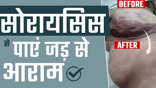 सोरायसिस से आराम कैसे मिला? | Psoriasis Patient Recovery | Dr. Megha Chaturvedi