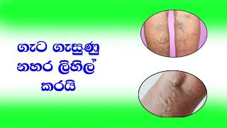 Varicose cure -නහර ගැට ගැසීම සුවකිරීම උදෙසාම උසස් අයුරින් නිපදවා ඇති හෝමියෝපති නිෂ්පාදනයකි.