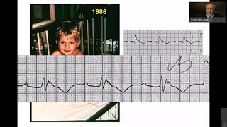 Lo más nuevo en Sindrome de Brugada. Todo lo que siempre quisiste saber  contado por su descubridor