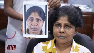 DRAMATIC Facelift Before and After Surgery Results India