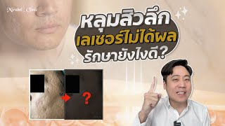 เป็นหลุมสิวลึก เลเซอร์แล้วไม่ได้ผล รักษายังไงดี ?