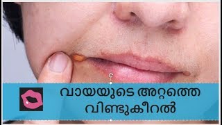 വായയുടെ അറ്റം വിണ്ടുകീറൽ / angular cheilitis home remedy