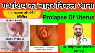 गर्भाशय का बाहर निकल आना | Sepia 30 for prolapse of uterus | Dr.MohitTawar Homoeopathy