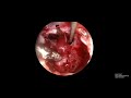 craniopharyngioma keyhole and endonasal endoscopic surgery