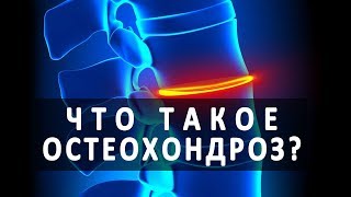 Что такое остеохондроз и как его лечат?