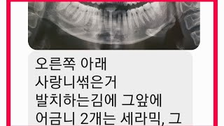 사랑니 뽑는 시기와  호구되지 않는 법