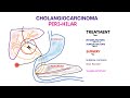 hilar cholangiocarcinoma גידול קלצקין