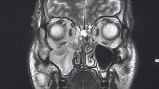 Normal dental procedure leads to emergency brain surgery