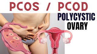 PCOS symptoms and treatment | Polycystic ovary syndrome in Hindi