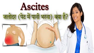 जलोदर रोग क्यों होता है? || What is the most common cause of ascites?|| #Aman#Atozmedicine