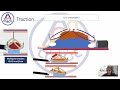 focus traction mentality in endoscopic submucosal dissection esd