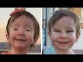 Toddler born visually impaired opens her eyes properly thanks to corrective surgery | SWNS