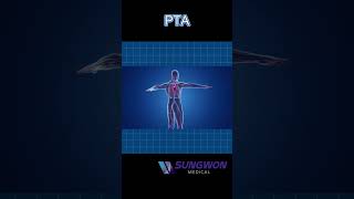 PTA (Percutaneous Transluminal Angioplasty) ബലൂൺ സ്റ്റെൻ്റ്?