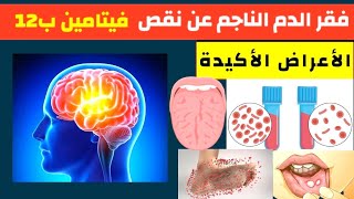 عوز فيتامين بي 12 و (فقر الدم) / أعراض نقص فيتامين B12 /كيف نزيد امتصاصه في المعدة