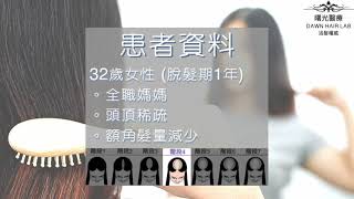 曙光醫療 Dawn Hair Lab【成功個案分享 - 32歲女性產後脫髮】