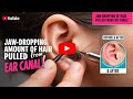 Jaw-Dropping Amount of Hair Pulled from Ear Canal!