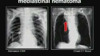 Imaging Aortic, Vascular and Mediastinal Injury in the Thorax