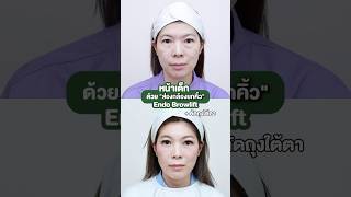 หน้าเด็ก ได้ด้วย ส่องกล้องยกคิ้ว (Endo- Browlift)