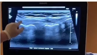 Lateral Knee MSK Ultrasound Targeted Scanning Demo of LCL and Biceps Femoris Insertion on the Fibula