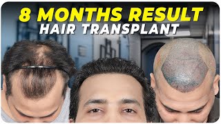 Hair Transplant in Dubai | Best Results & Cost of Hair Transplant in Dubai