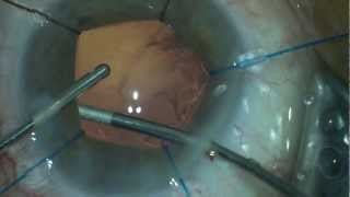 Capsular suspension during cataract surgery in pseudoexfoliation syndrom (PXF) for maximal safety