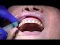 Prepless Veneers at Cosmetic Dental Associates in San Antonio, TX