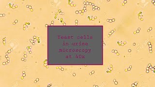 Yeast cells with budding in urine microscopy at 40X
