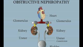 Ureterovesical Junction - Obstructive Nephropathy