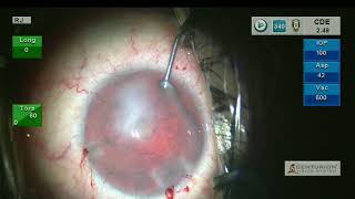 CME Episode 78: Cataract-IOL in an Aniridic Eye: The Artificial Iris