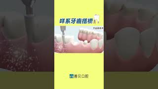 【醫生，乜係牙齒搭橋？】睇完您就知！【深圳口腔邊家好？咁係深圳善貝口腔啦】2023年度醫療服務質量A級單位+博士碩士領銜專科機構 #深圳牙科推薦 #深圳善貝口腔 #種植牙 #深圳牙科排名