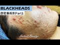 超密集粉刺part1( blackheads ) - Taiwan Tainan台南清粉刺最乾淨