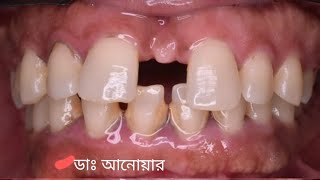 উঁচু ও ফাঁকা দাঁতের ব্রেসেস চিকিৎসা চলছে। Orthodontic braces treatment.