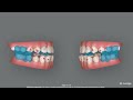 Invisalign Mandibular Advancement with Precision Wings