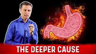 The Real Causes of Acid Reflux, Heartburn & GERD – Dr.Berg